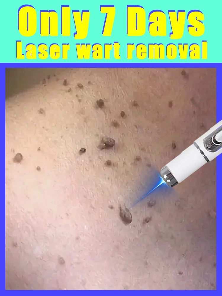 Darmowa wysyłka, długopis na brodawki z niebieskim światłem, narzędzia do pielęgnacji brodawek, unisex, hit sprzedaży 2025