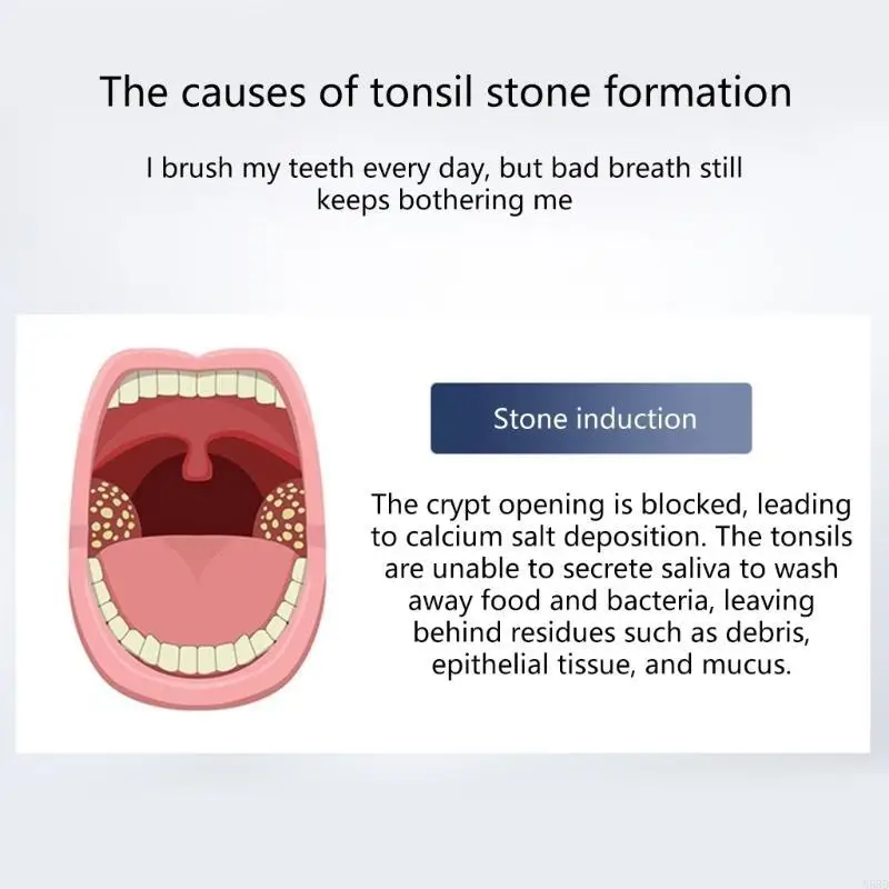 أداة شفط أحجار اللوزتين تتميز بـ 3 مجسات ناعمة و3 شدات شفط N58D #3