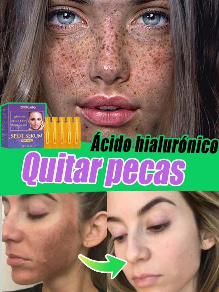 Las pecas desaparecen sin repeticiรณn