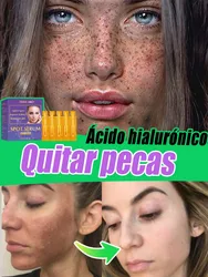 Las pecas desaparecen sin repetición