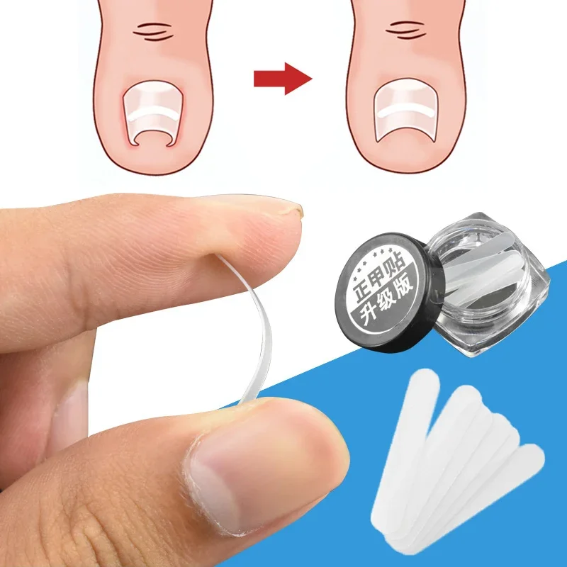 

10pcs Ingrown Toe Nail Treatment Ingrown Toenail Correction Tool Elastic Patch Sticker Straightening Clip Brace Pedicure Tools