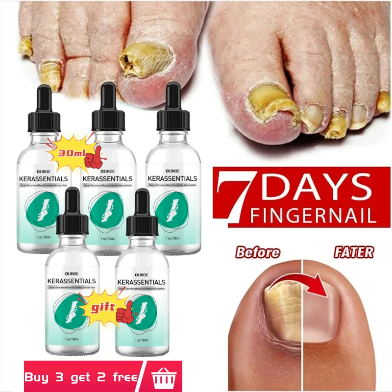 Nail Fungus Treatment Gel Herbal Nail Treatment Repairing Thickened Gray Nails Relieve Ingrown Nail Cleaning Anti Infection Care