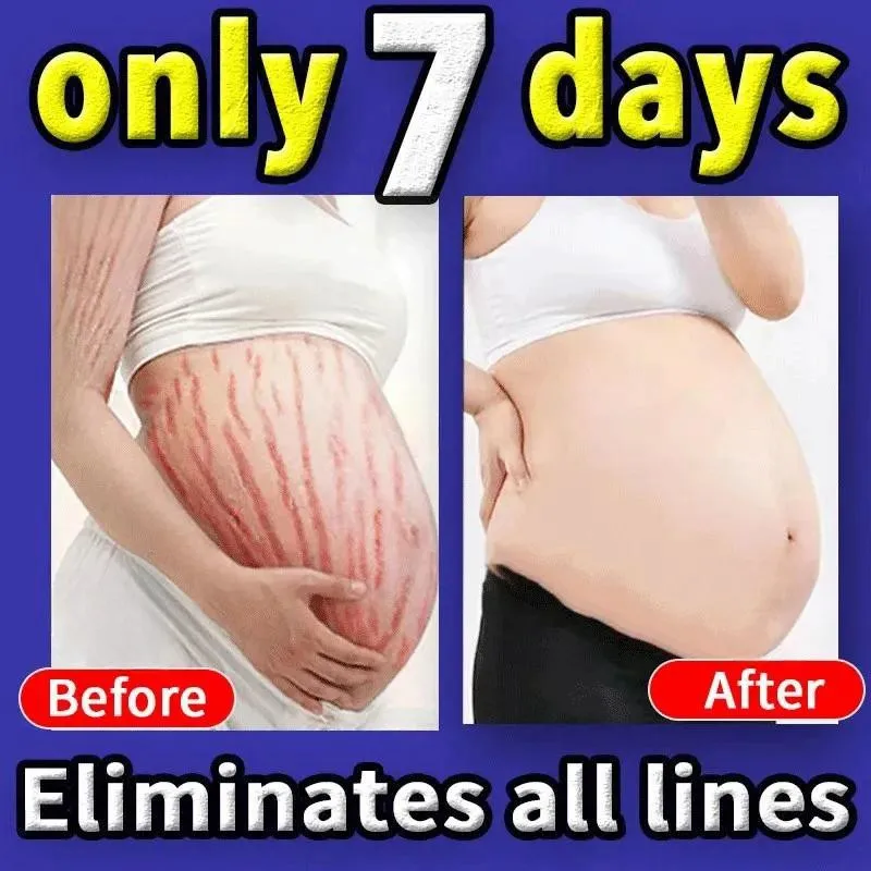 

7 Day Stretch Marks Permanent Removal Cream Eliminate Body Belly Stretch Marks For Tunnels Anti-Winkle Firming Skin Body Care