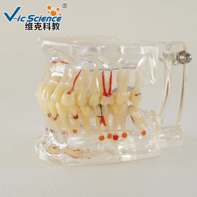 

Dental Model Full Mouth Teeth Pathology Model With Half Implant