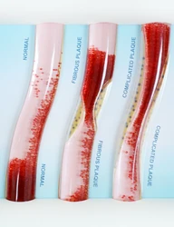 Anatomical Low-Density Lipoprotein LDL Blood Vessel Model for Medical Patient Doctor Teaching